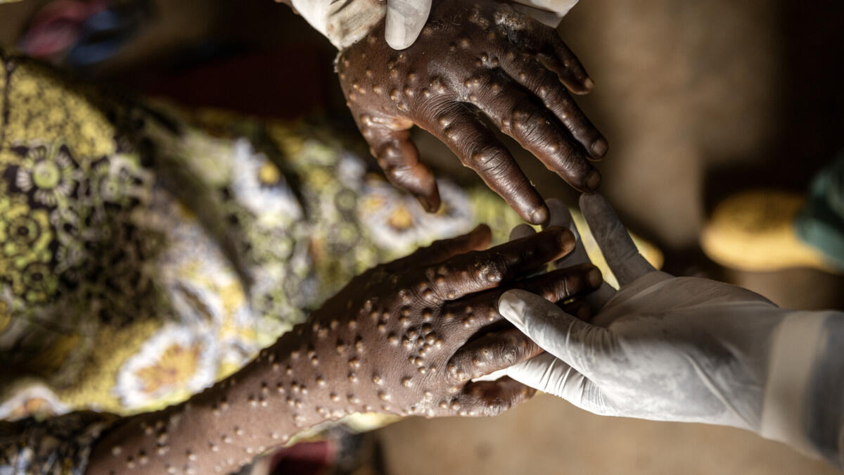 Portugal records community transmission of mpox and 66 recent infection cases