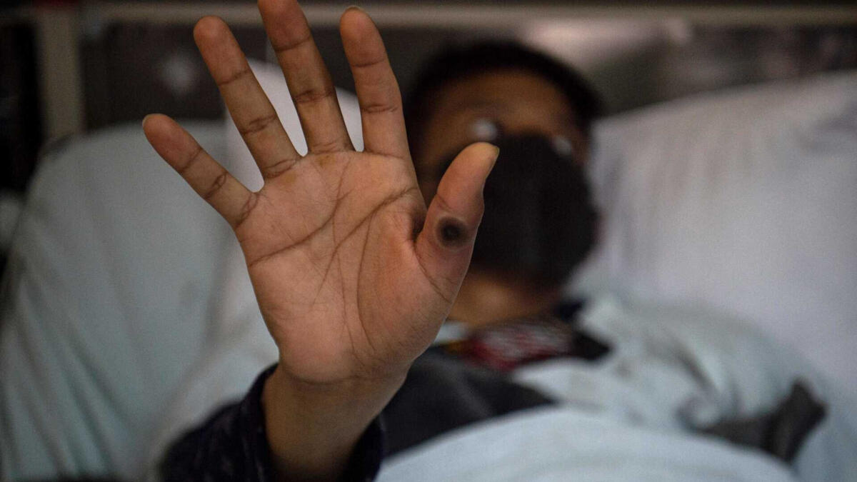 Portugal sees increase in mpox transmission since 2025 with 282 cases this year