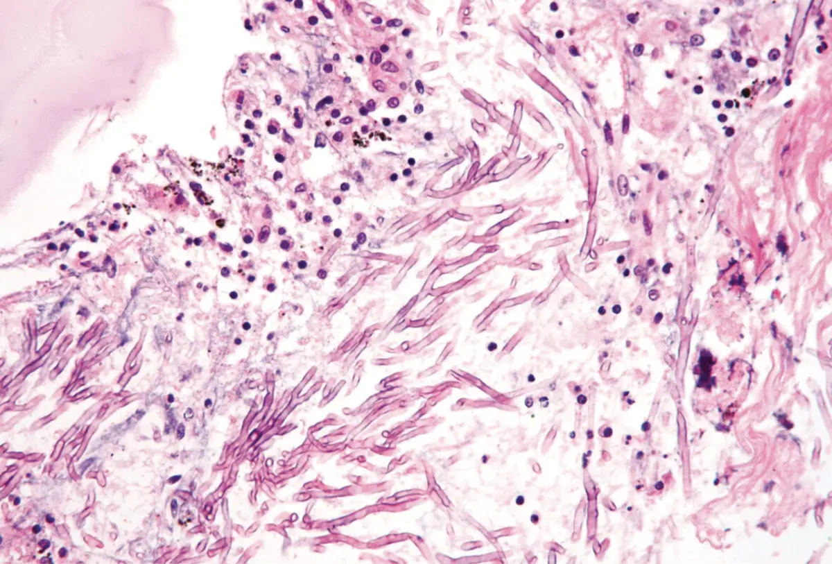 Imagem de contexto do artigo Contraiu infeção após cheirar meias sujas todos os dias