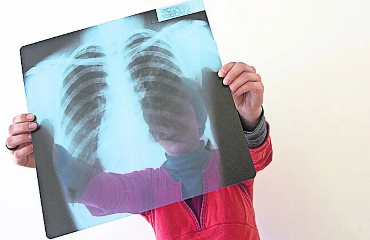 Rastreio do cancro do pulmão foi anunciado em 2022