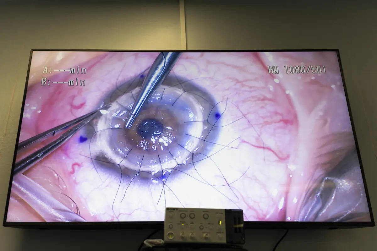 “Com as córneas de cultura passa a ser possível aumentar o número de córneas disponíveis para transplante, aumentar a sua qualidade e programar as cirurgias com mais tempo”, resumiu Miguel Neves