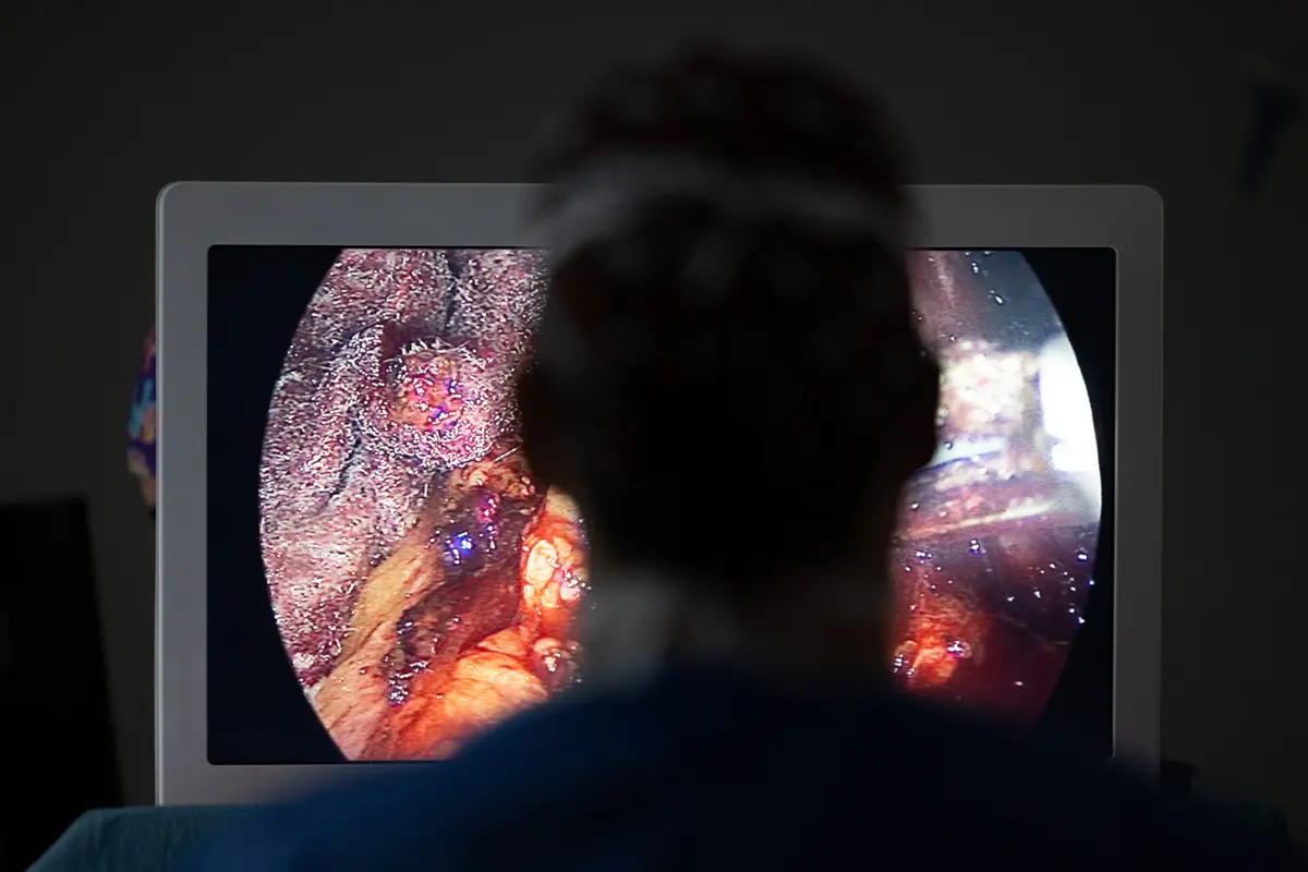 Mais de metade (60%) da população adulta com obesidade sofria de doença crónica ou problema de saúde prolongado