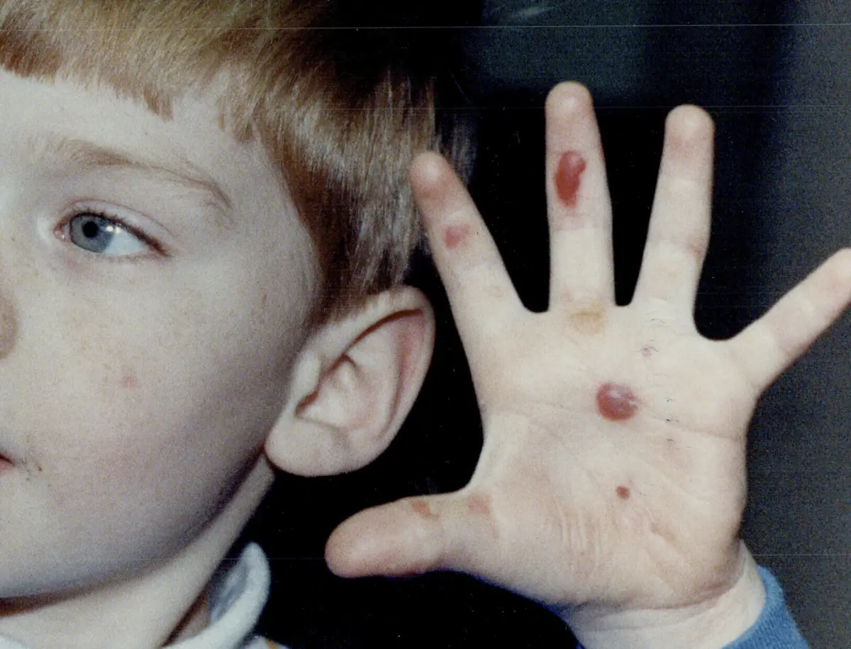 Doença caracteriza-se pelo aparecimento de bolhas e até feridas abertas na pele e nas membranas mucosas