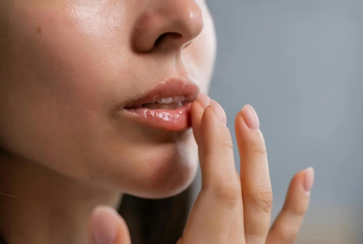 Lábios fissurados durante muito tempo podem exigir visita a um médico