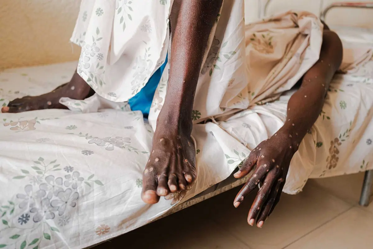 OMS declarou uma emergência sanitária internacional devido à propagação da mpox