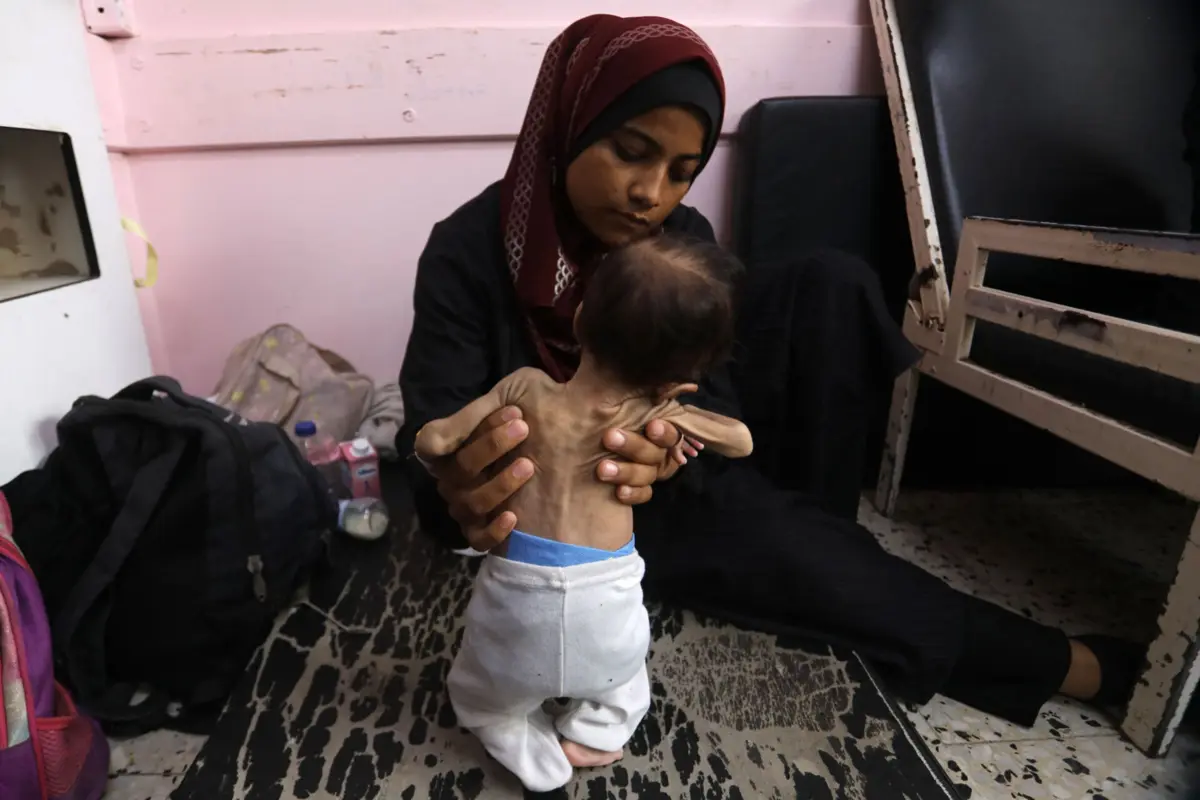 Todos os dias, a equipa da organização Médicos Sem Fronteiras regista 25 novos doentes desnutridos