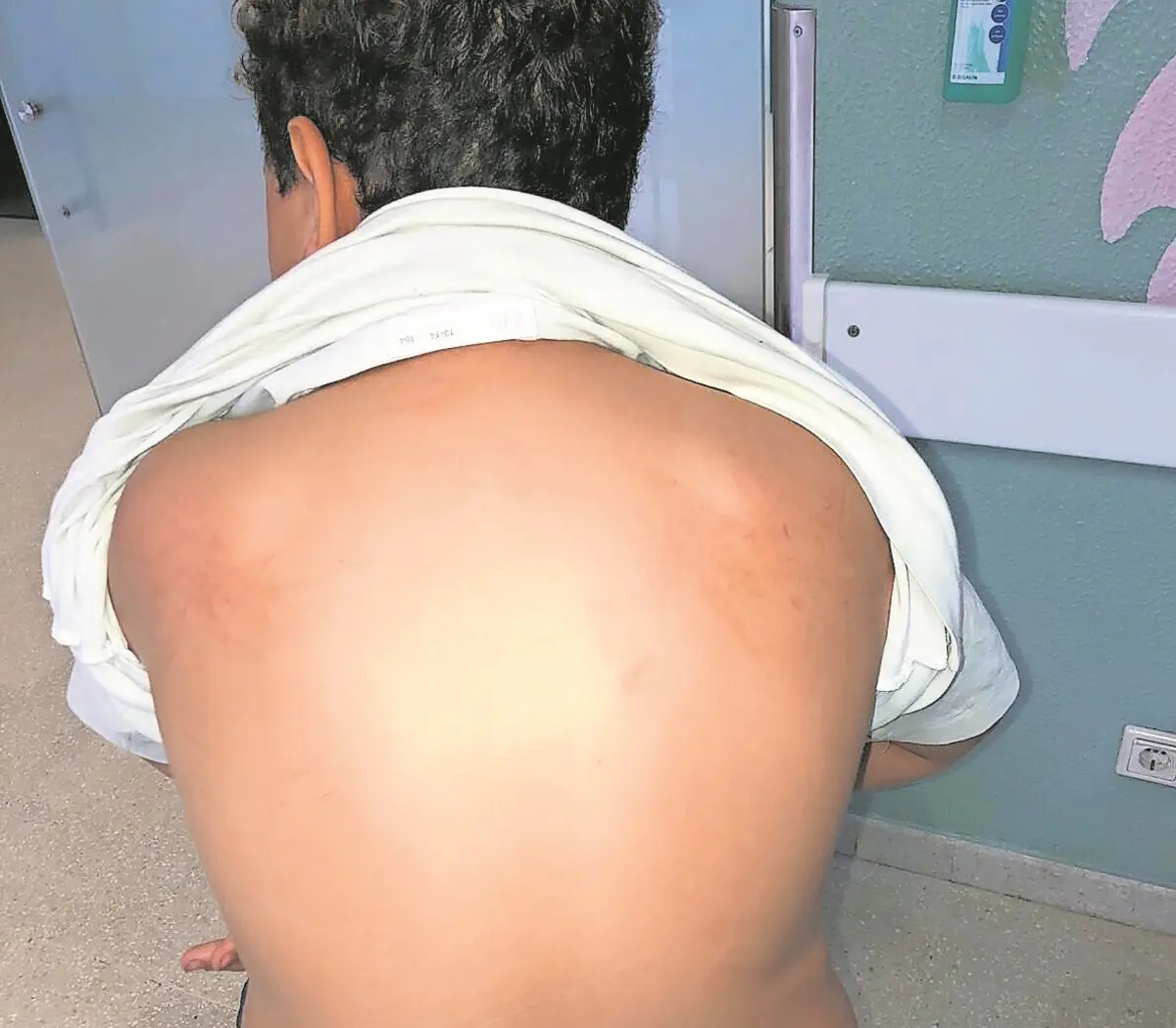 Mãe diz que manchas nas costas do filho resultaram da agressão