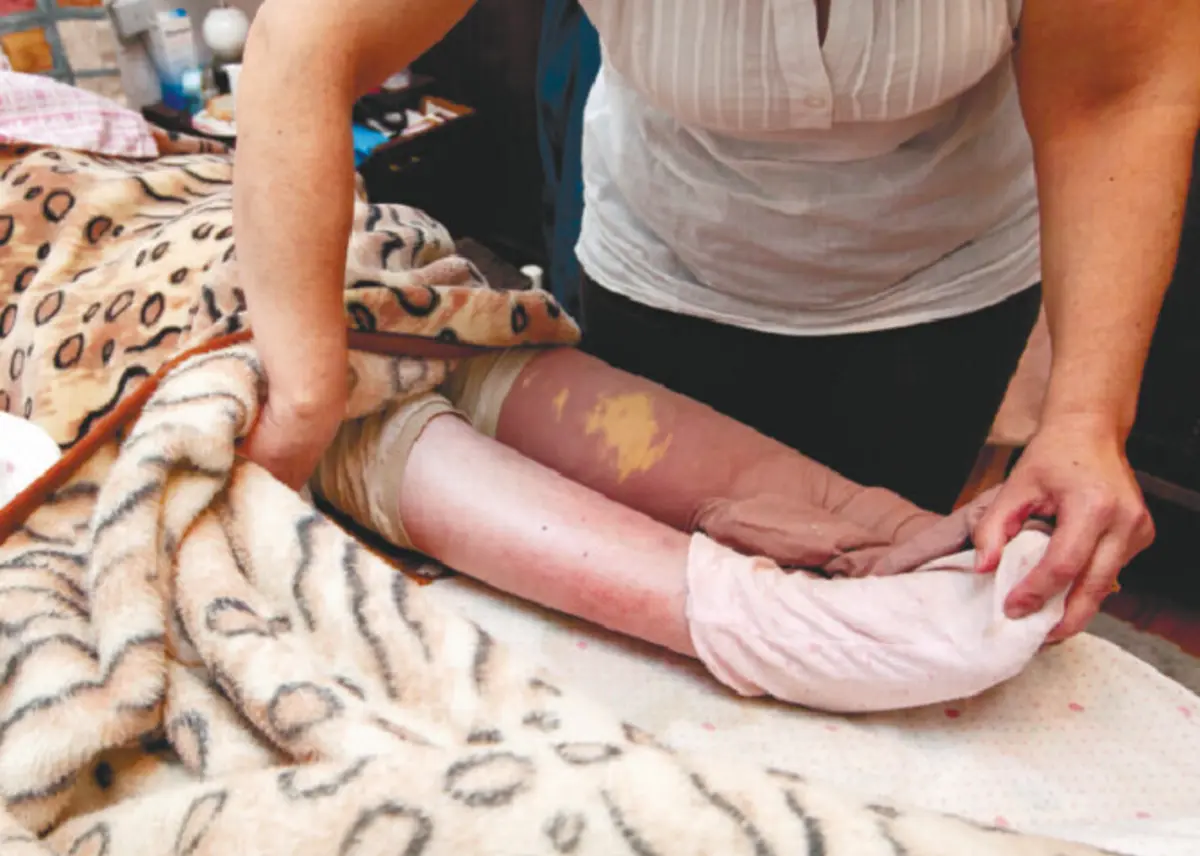 Utente de 83 anos morreu. Quando foi transferida do lar tinha "múltiplas úlceras de pressão" no corpo