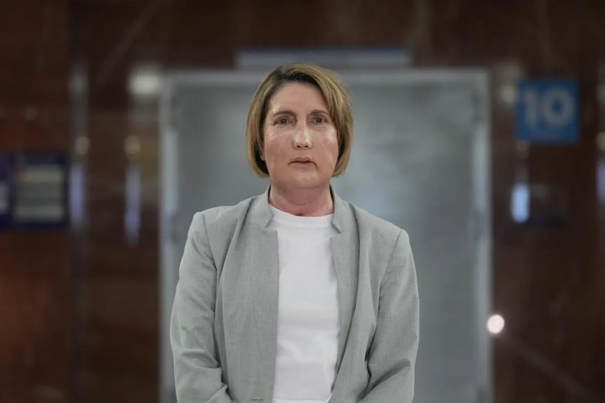 Carme necessitava de um transplante da parte central do rosto