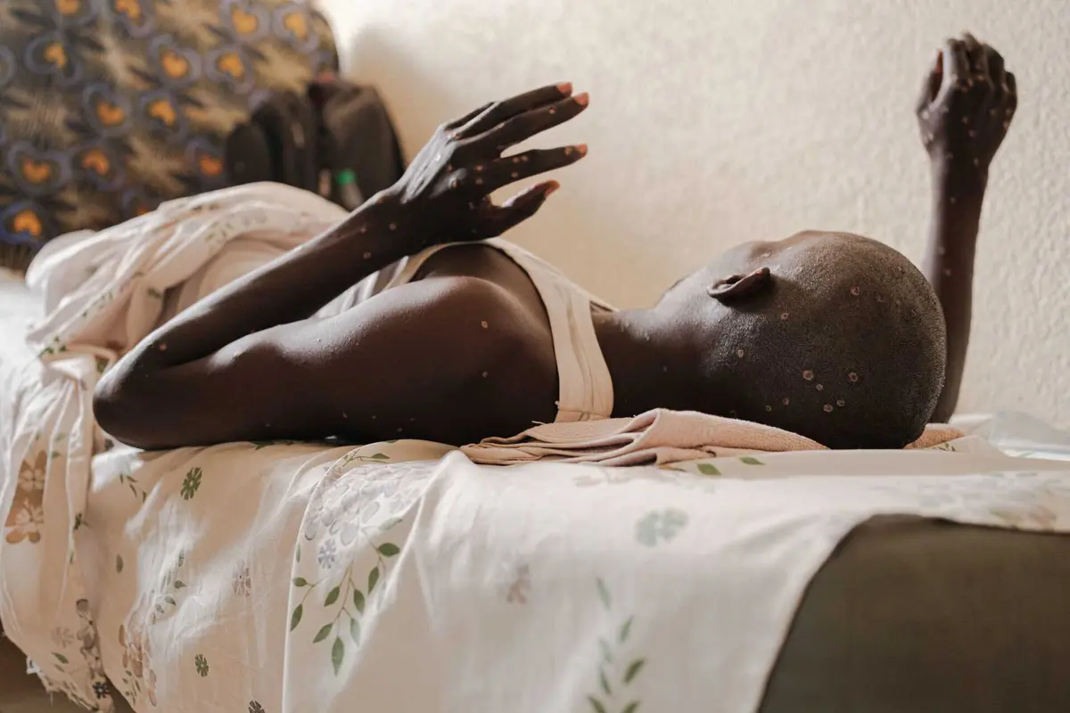 Imagem de contexto do artigo Portugal vai doar vacinas contra a Mpox a países africanos