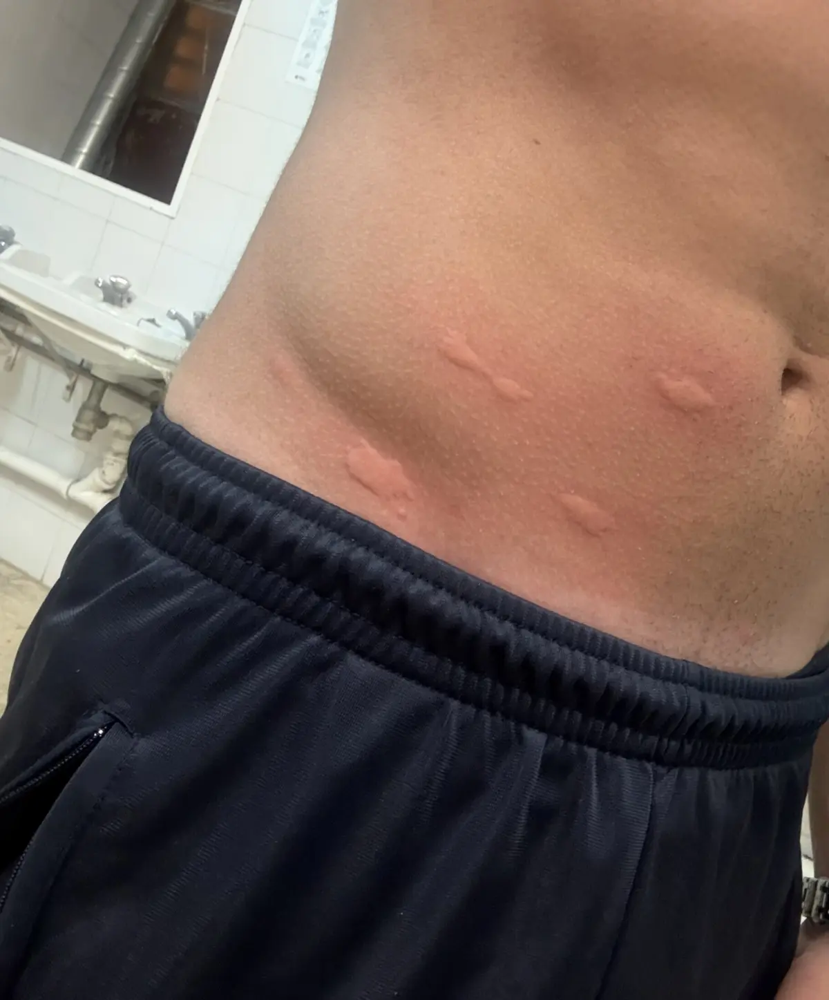 Lesões no abdómen de um militar da GNR afetado