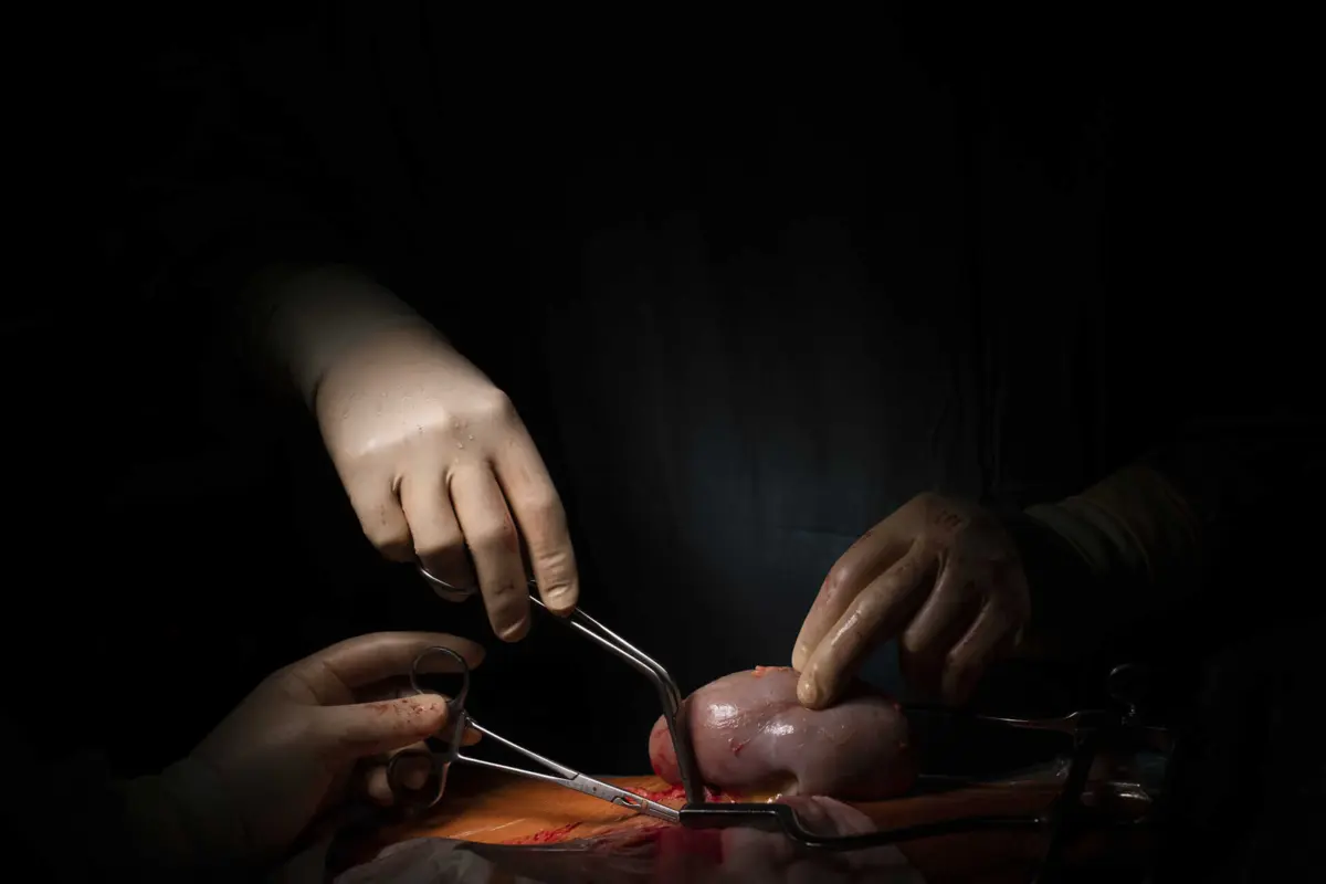 Mais de 500 transplantes renais foram feitos no ano passado