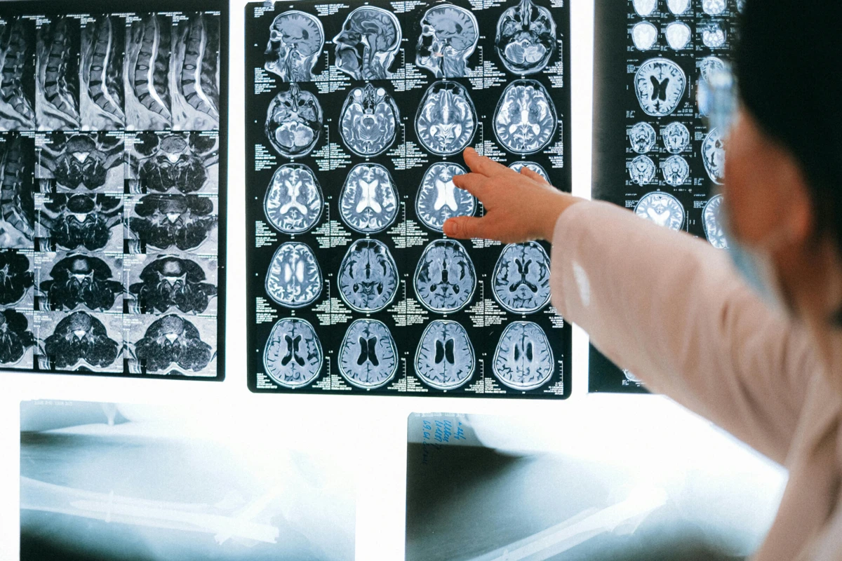 A doença de Parkinson afeta quase 10 milhões de pessoas em todo o mundo
