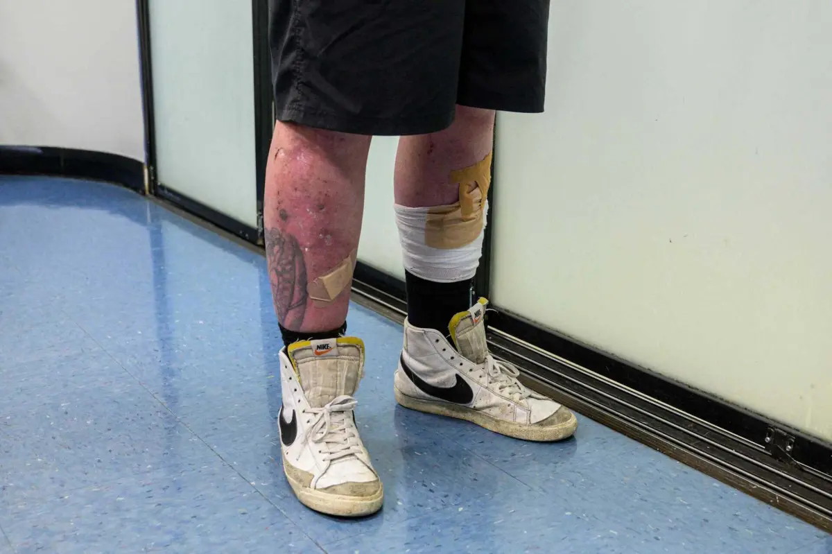 Nova e poderosa combinação de drogas sintéticas causa ferimentos que se assemelham a queimaduras