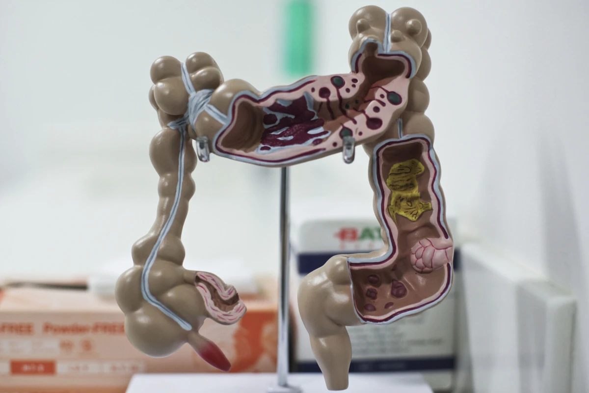 Imagem de contexto do artigo Mais de 400 cancros do intestino na região Norte em 2021