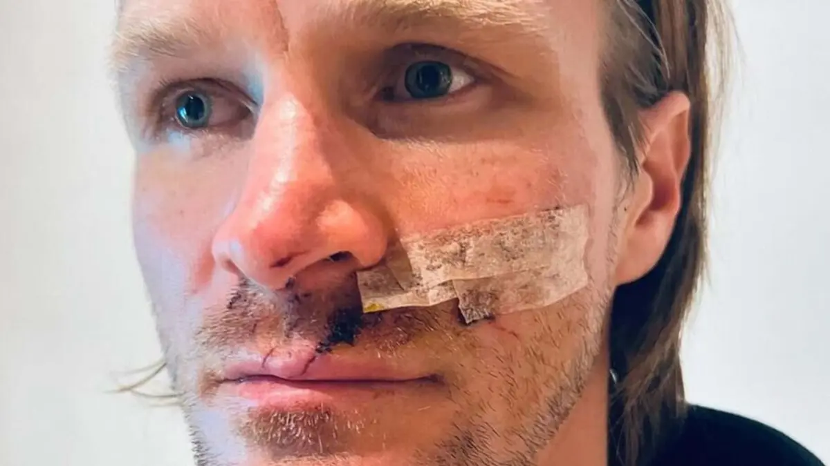 Tadeusz Blazusiak ficou com graves lesões no rosto na sequência do acidente