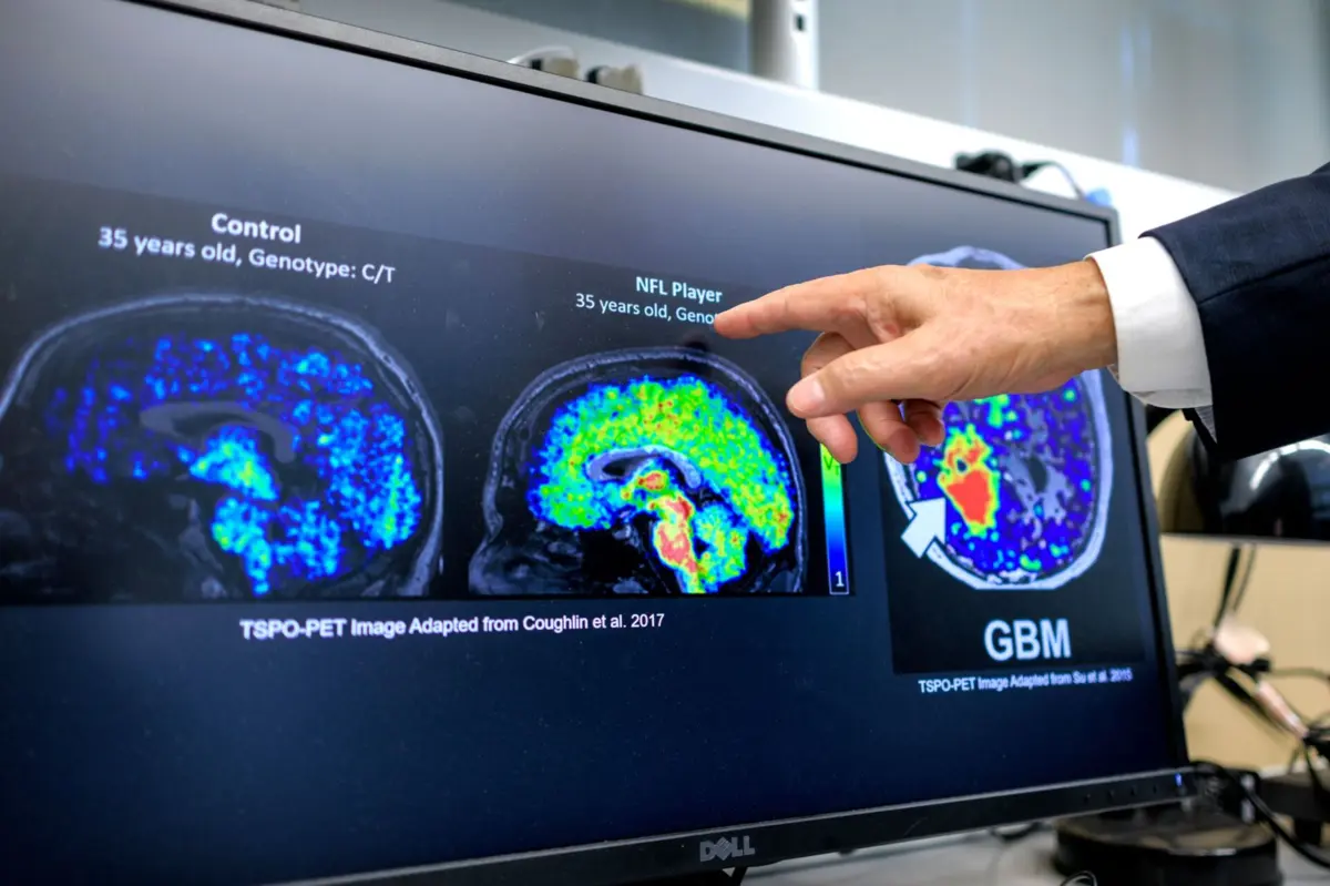 Há fatores que explicam a doença de Alzheimer
