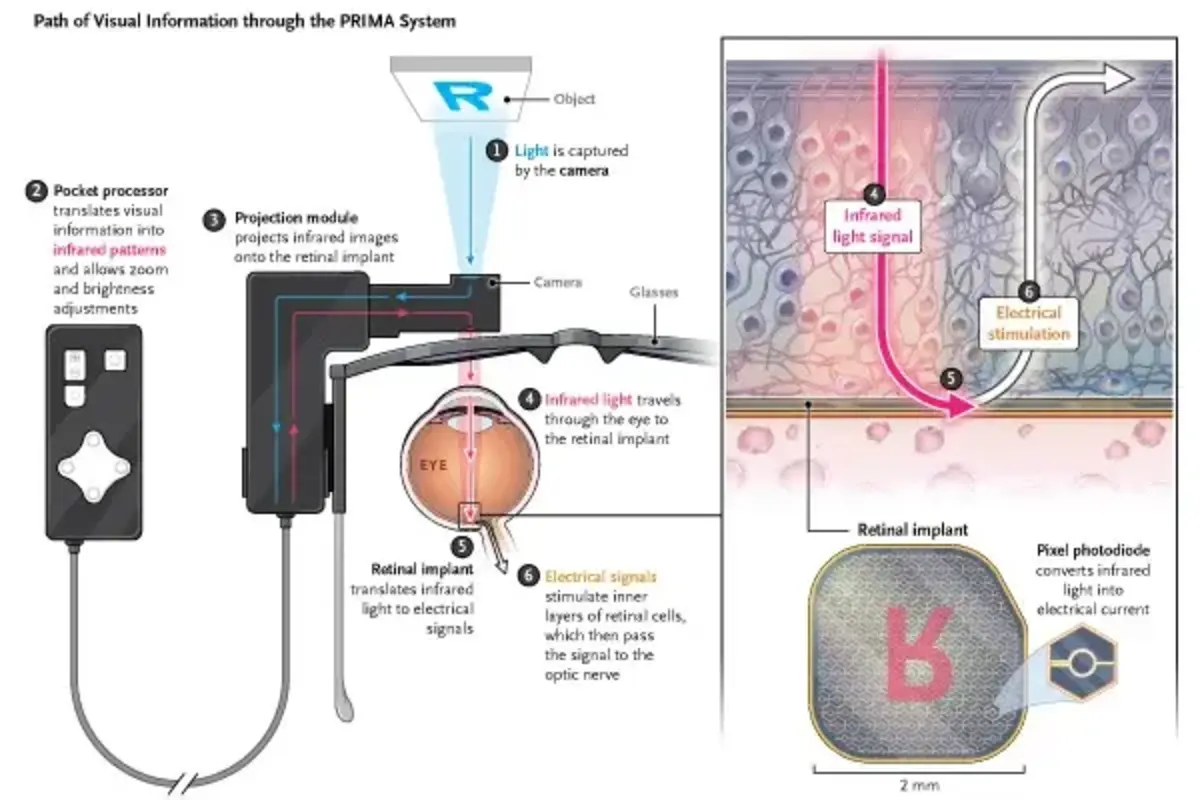 Implante sem fios colocado na retina pode restaurar a visão central
