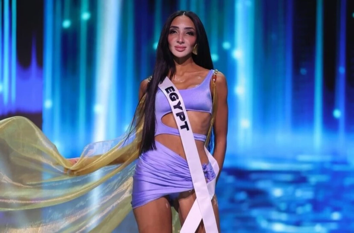 Candidata do Egito, Logina Salah, foi vítima de bullyng devido a doença e quer consciencializar os mais jovens