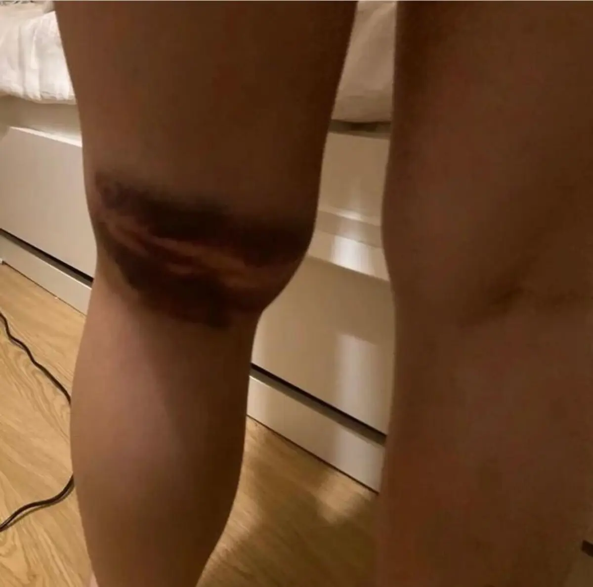 Alegadas marcas da agressão da PSP