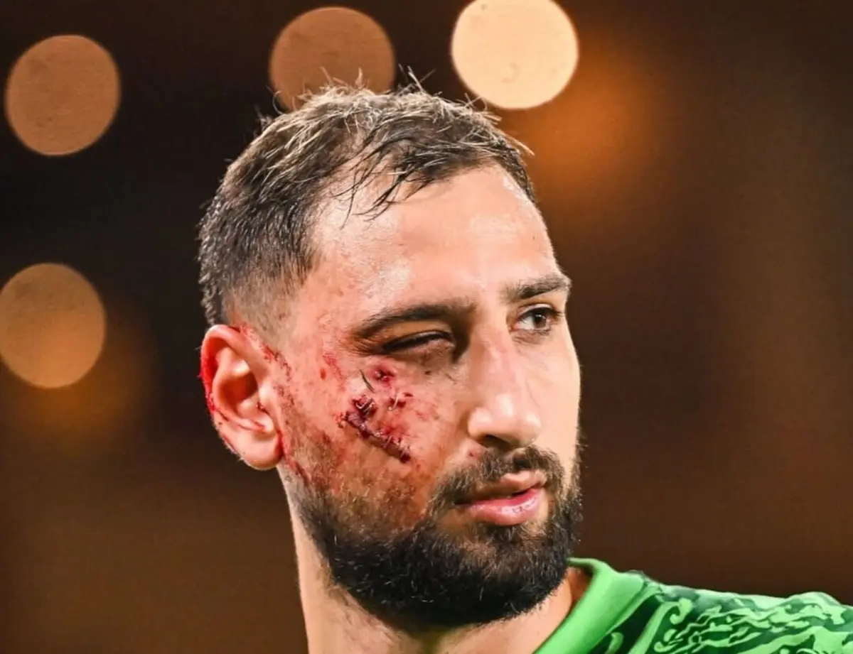 Estado em que ficou a cara de Donnarumma (créditos: Instagram)
