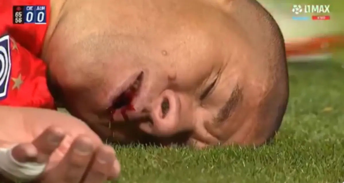 Imagem de contexto do artigo Perdeu três dentes e teve de ser operado por uma cotovelada... e foi só amarelo. Ora veja