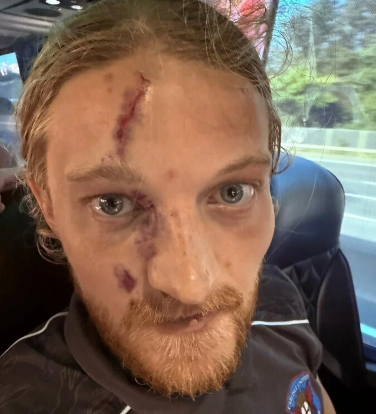 Estado em que ficou a cara de Luke Armstrong (créditos: Carlisle)